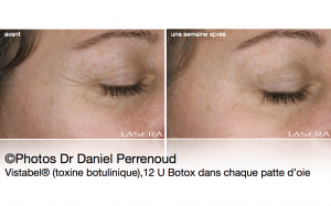 Vistabel® (toxine botulinique), 12 U Botox dans chaque patte d’oie ©Photos Dr Daniel Perrenoud