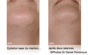 Epilation laser du menton, après deux séances. Epilation laser du menton, après deux séances.